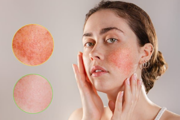 redness skin